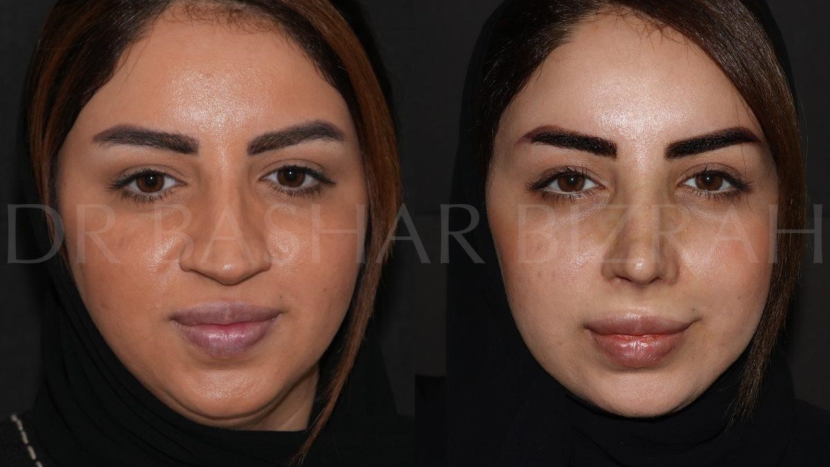 closed rhinoplasty near me