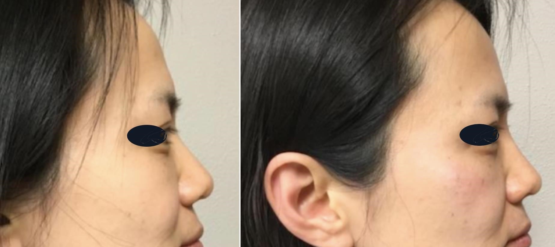 closed rhinoplasty near me