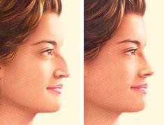 closed rhinoplasty near me